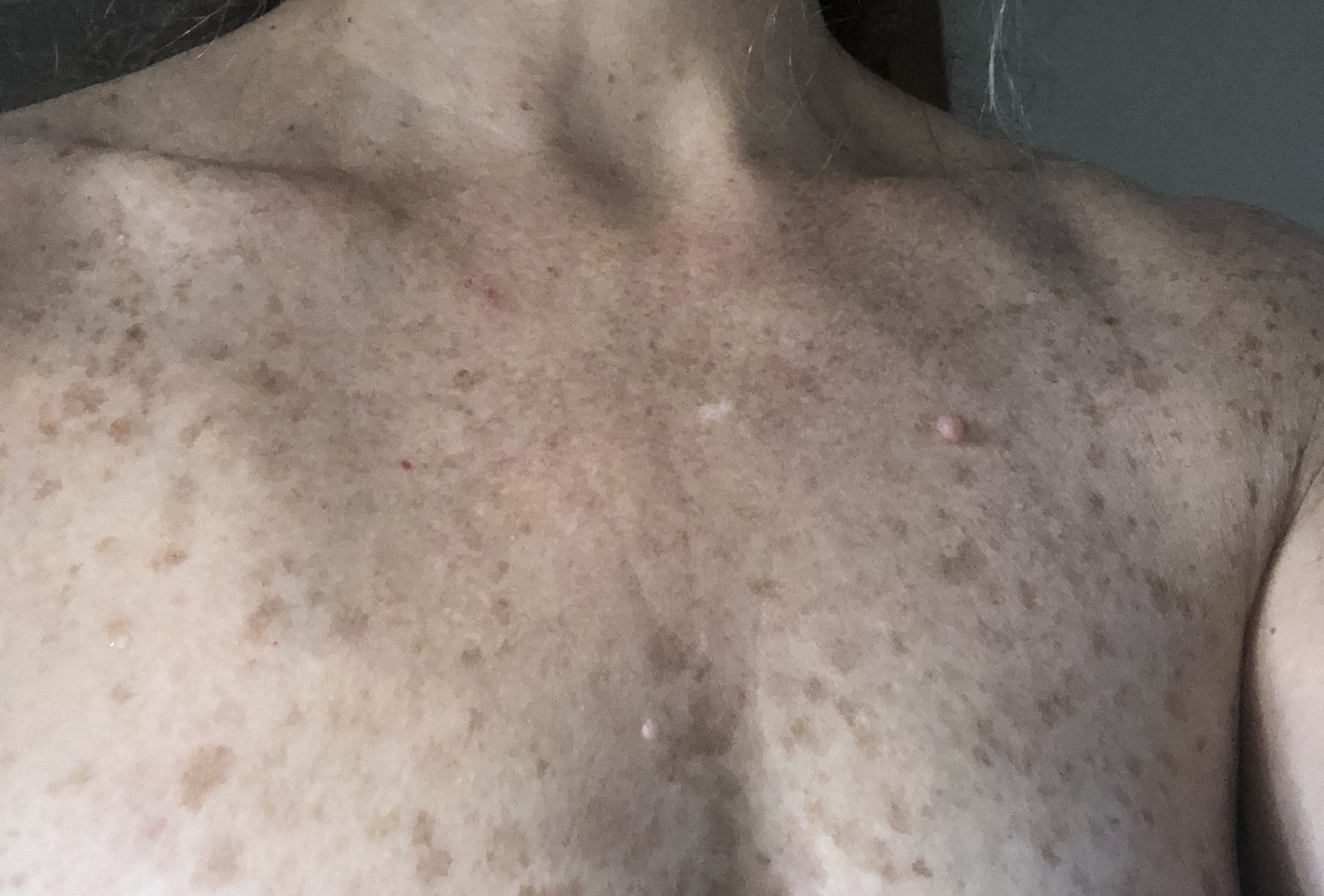 IPL Skin Rejuvenation DermPhysicians of New England