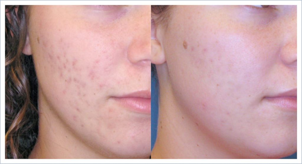 Acne Treatments Dermatology Realm Germantown, TN
