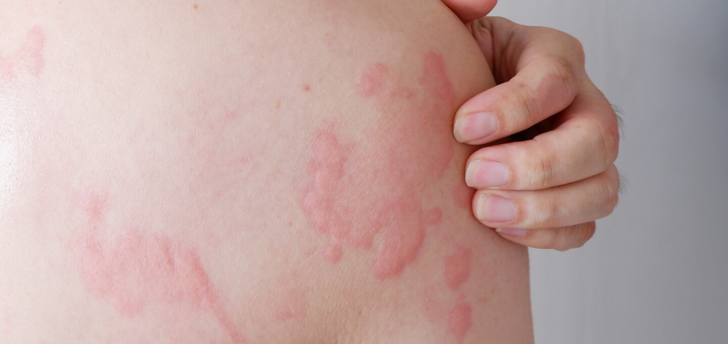 Hives Dermatology and Skin Health Dr. Mendese