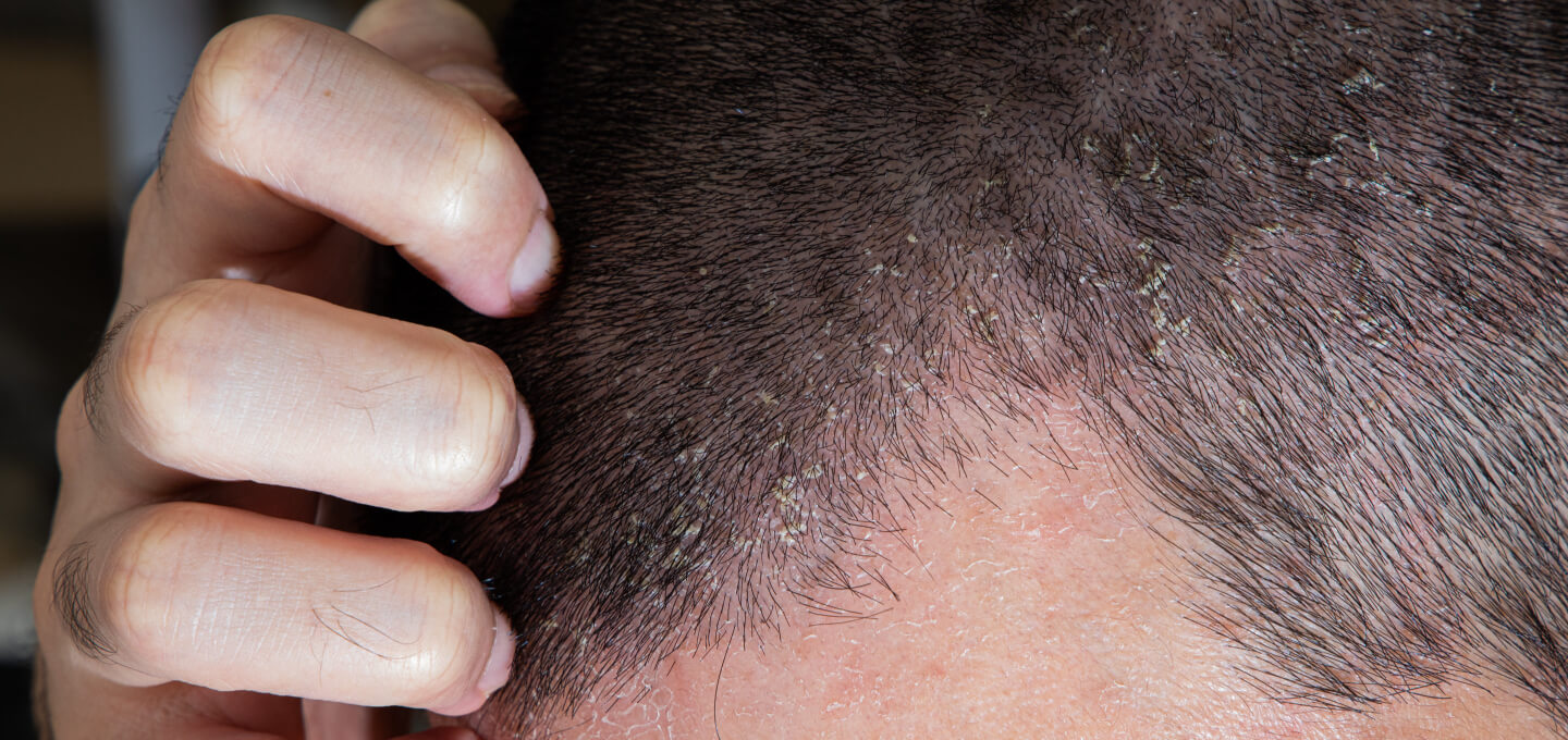 Eczema On Scalp African American
