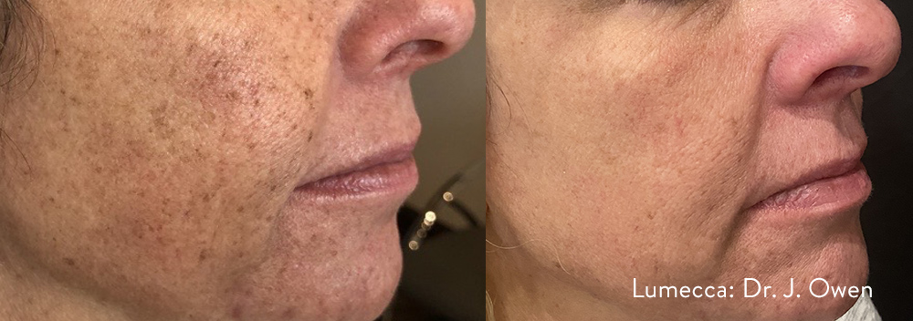 IPL (Photofacial) Wallin