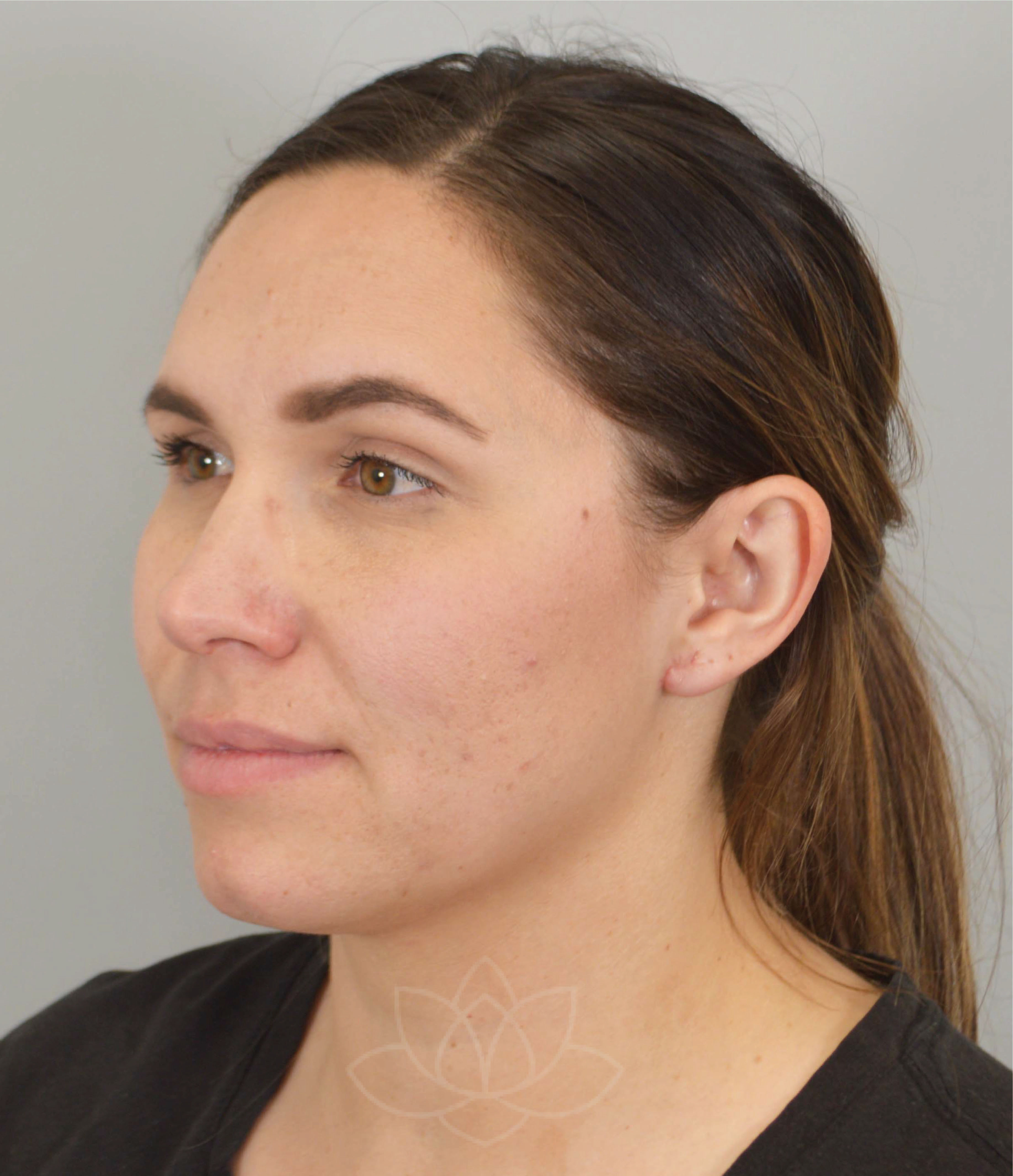 Desert Bloom Plastic Surgery Earlobe repair St. Utah