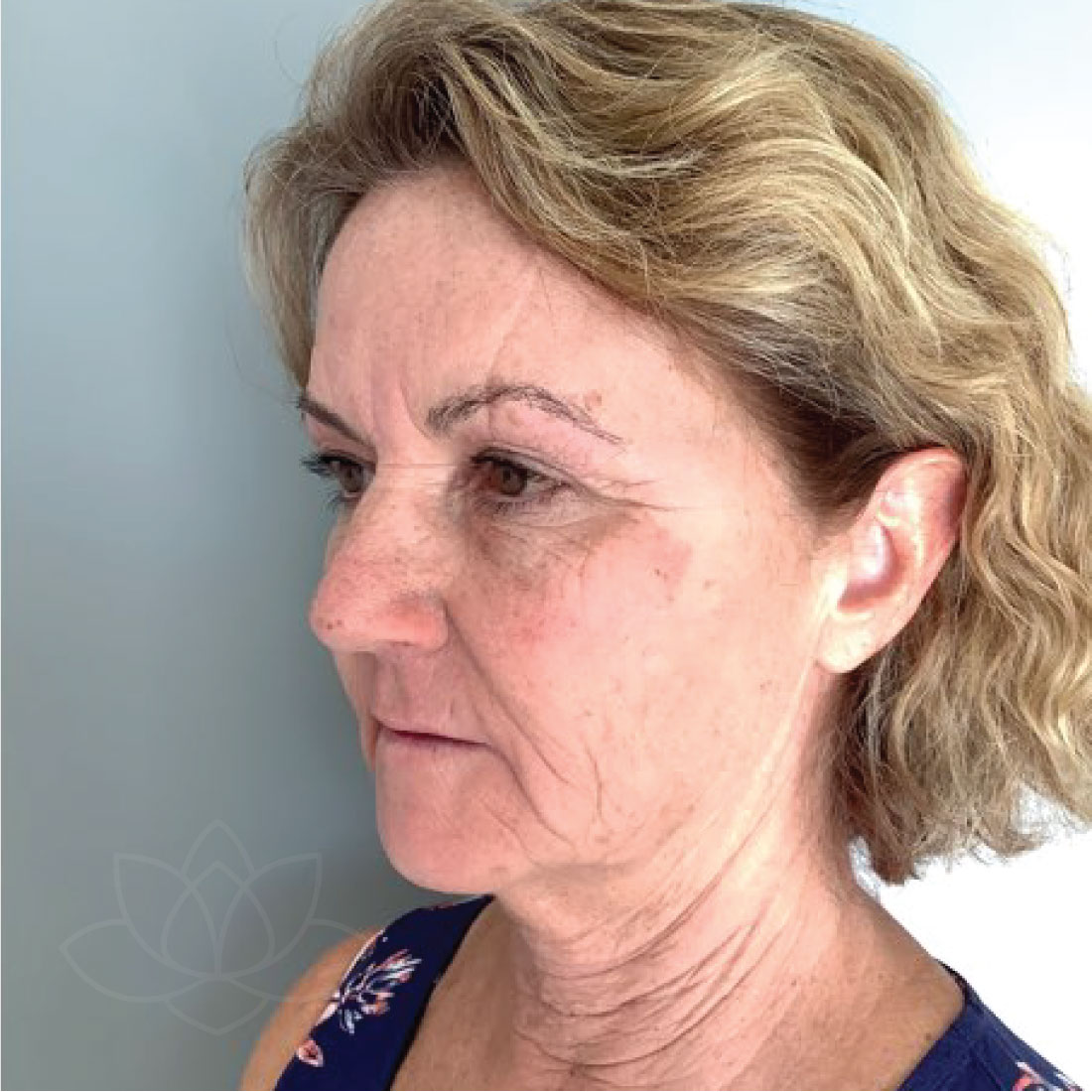 Facelift before & afters Desert Bloom Plastic Surgery St. Utah