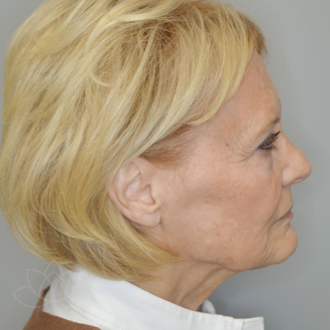 Facelift before & afters Desert Bloom Plastic Surgery St. Utah