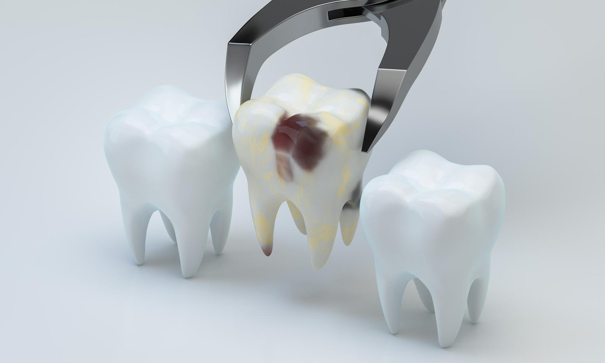 How Long to Keep Gauze In After Tooth Extraction?
