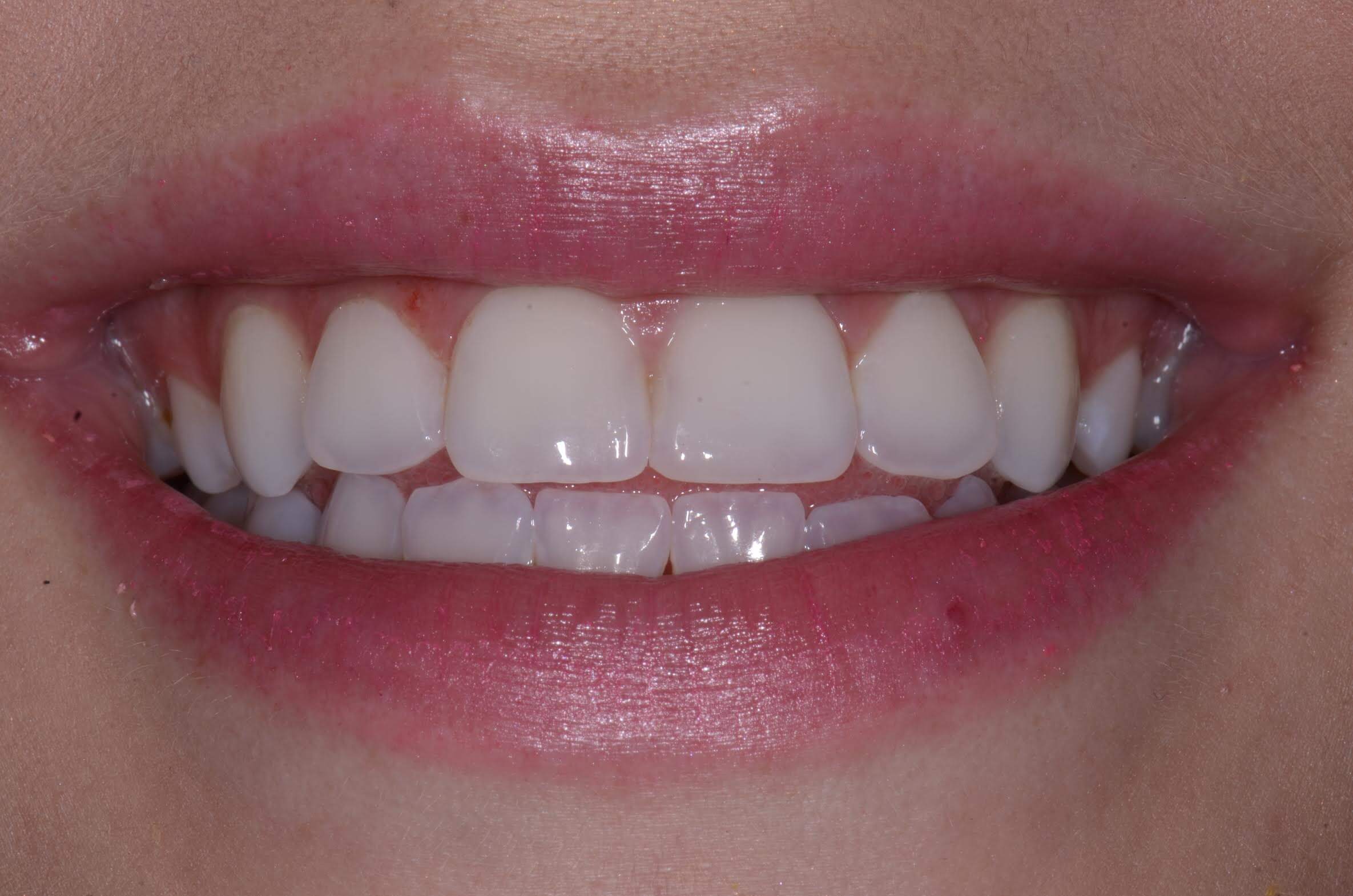 How Small Aesthetic Dental Repairs Can Make A Big Difference