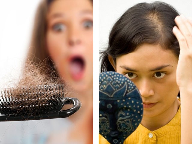 Ang pagkawala ng buhok sa mga kababaihan sanhi ng pagkawala ng buhok at paggamot sa bahay