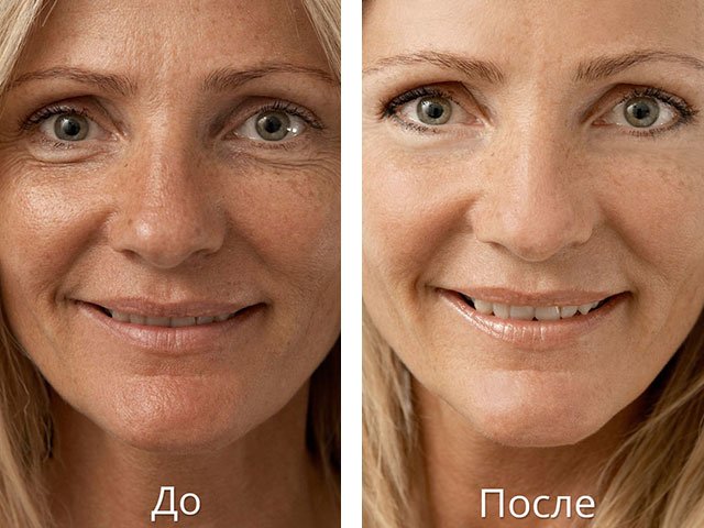Acide hyaluronique pour photo du visage avant et après