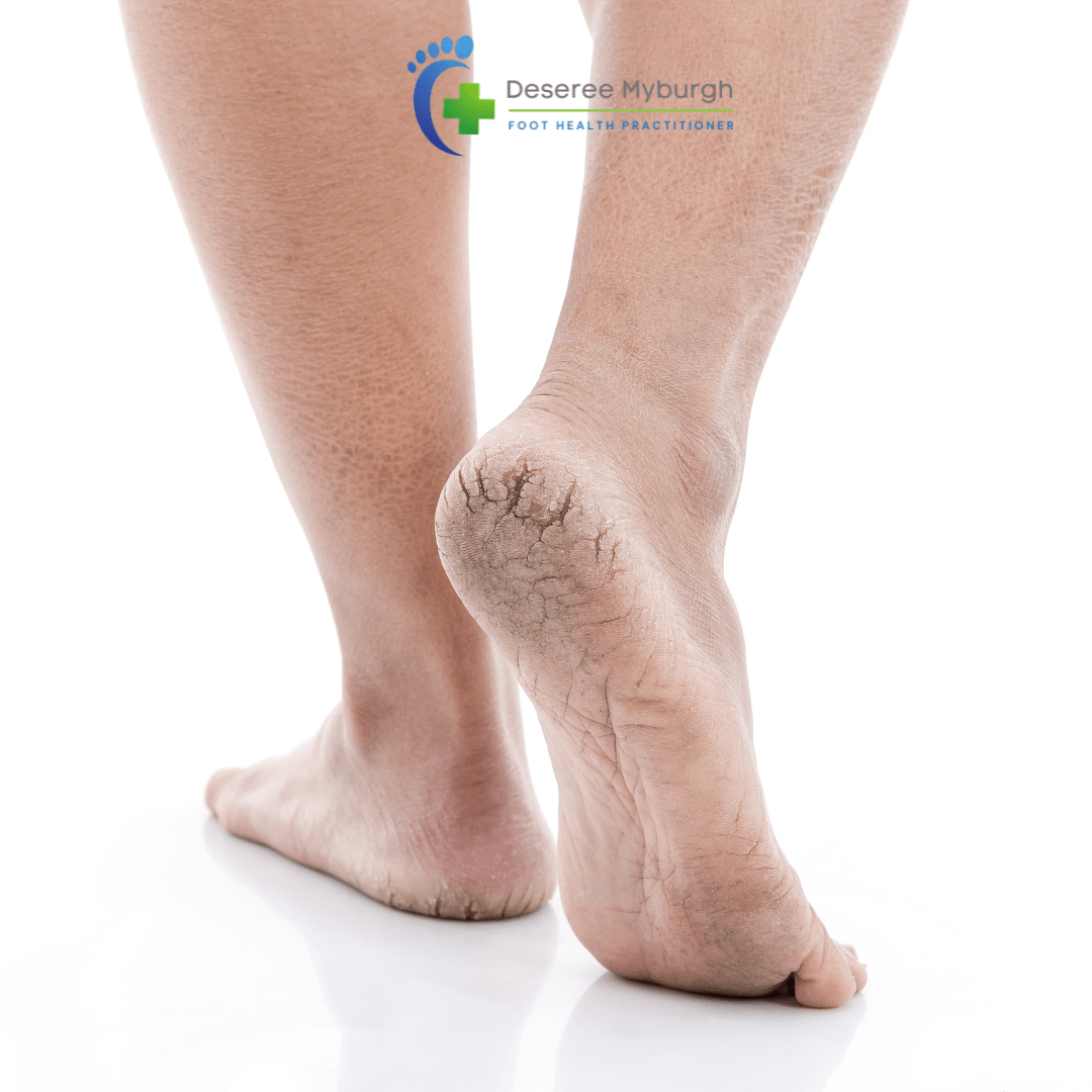 Cracked Heels / Fissures Deseree Myburgh Foot Health Practioner