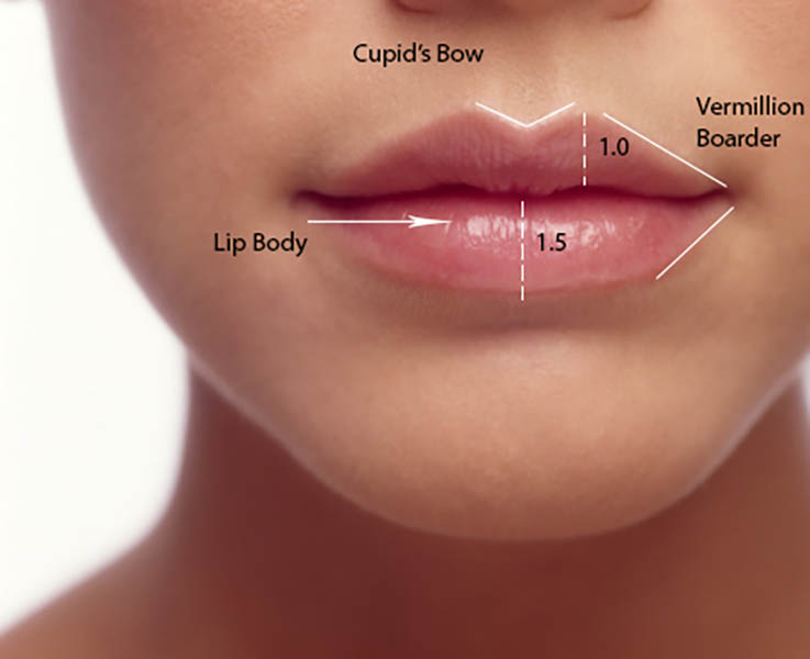 Lip Fillers: How Long They Last, Before & Afters, Side.