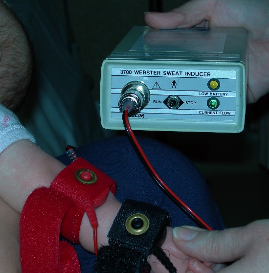 Having a sweat test CoughDoc Dr. Ian BalfourLyyn