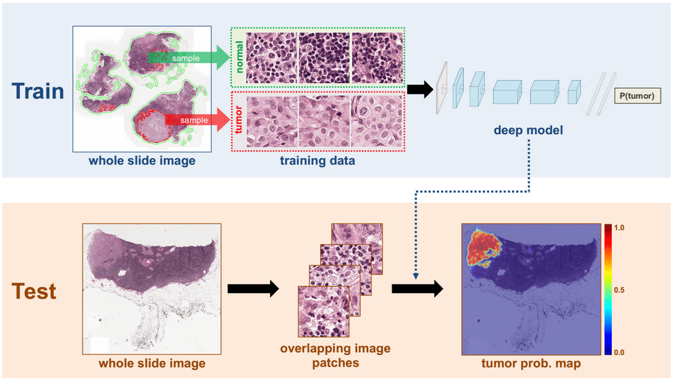Deep Learning System Improves Breast Cancer Detection NVIDIA