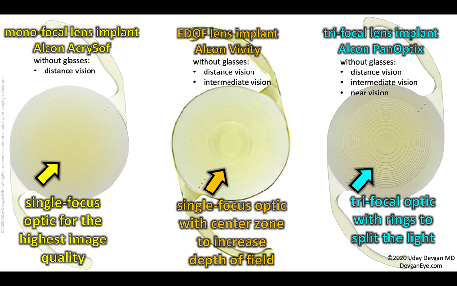 Lens Implant Options by DevganEye Surgery