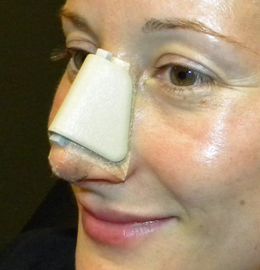 Rhinoplasty Postoperative Advice and Instructions Deviated Septum