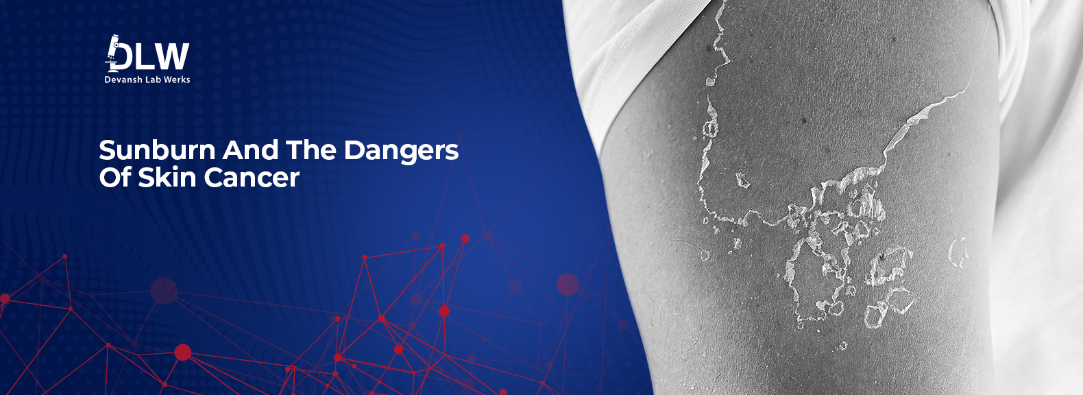 Sunburn And The Dangers Of Skin Cancer Devansh Lab Werks