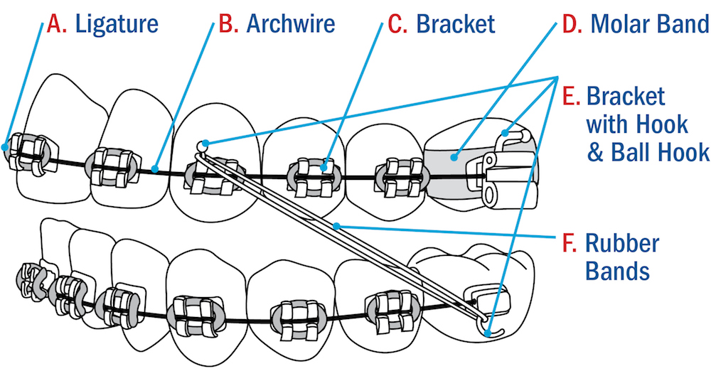 Braces Diagram Devon Ortho
