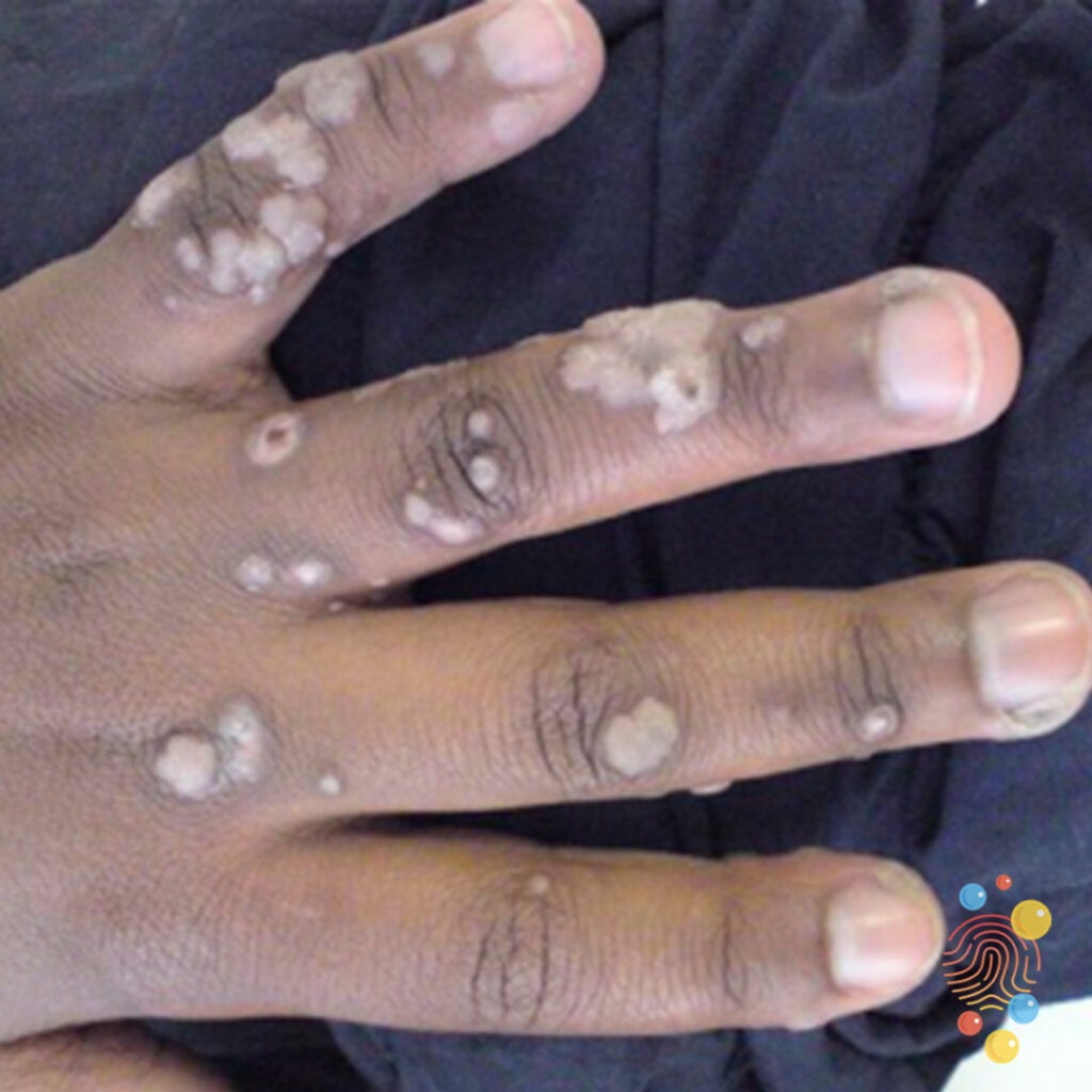 Warts Skin Deep