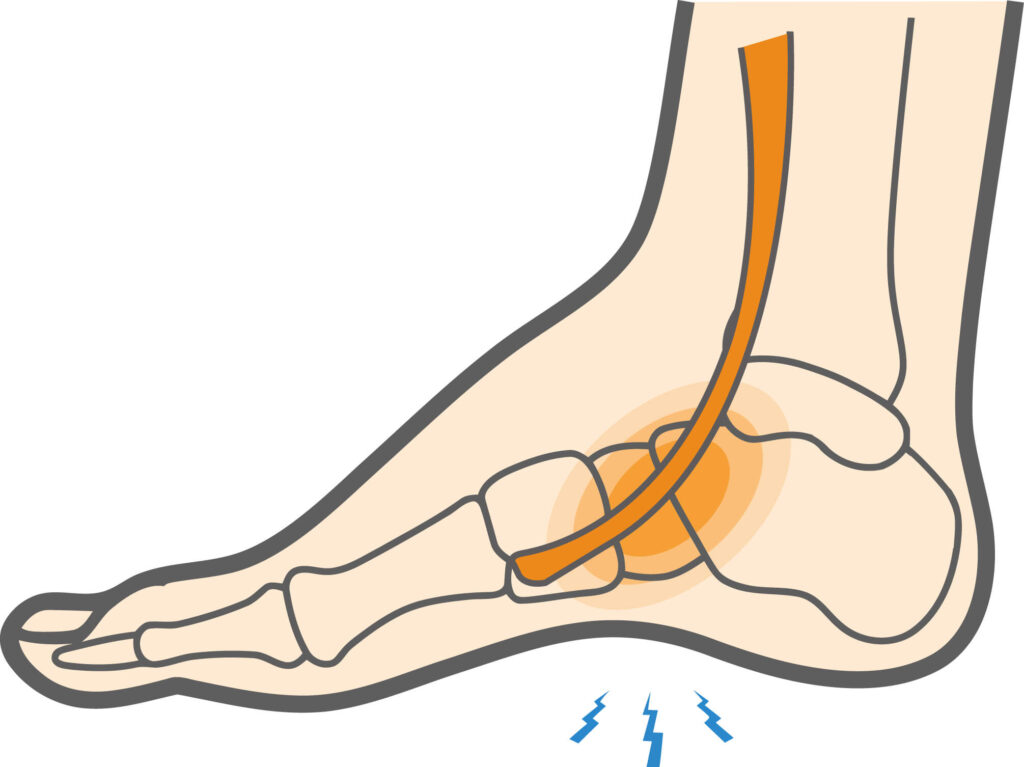 WhatIsExtensorTendonitisintheFoot DFW Wound Care Center Wound