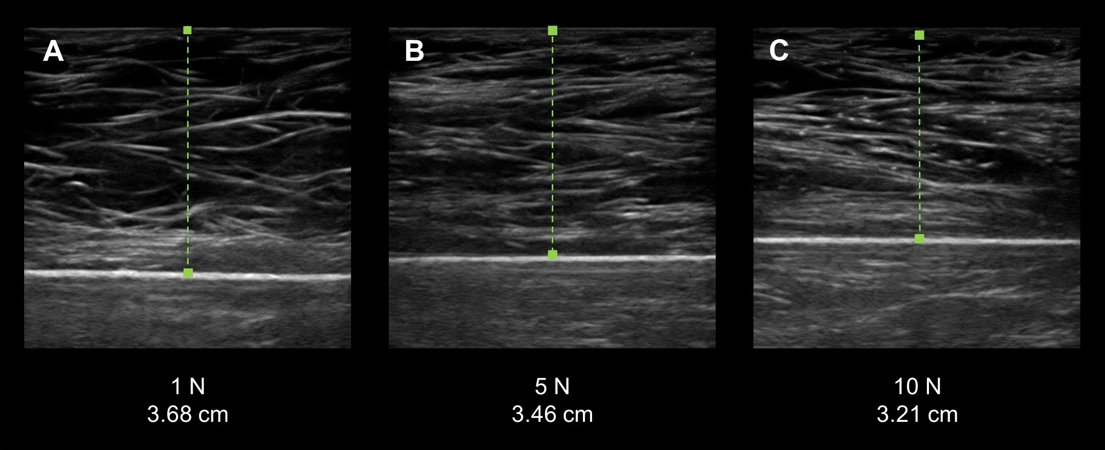 Interrater reliability of quantitative ultrasound using force feedback
