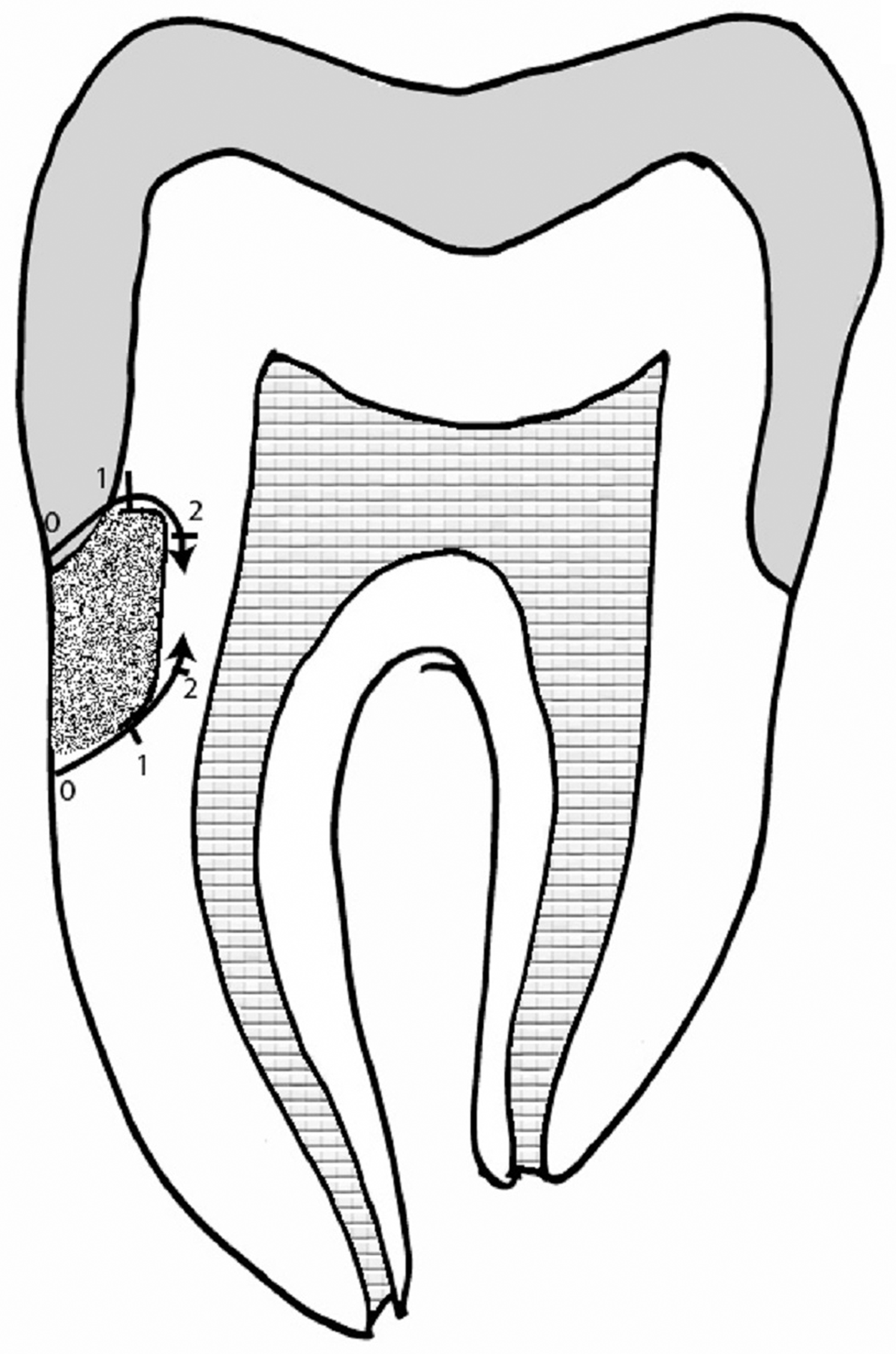 Comparison of microleakage between different restorative materials to