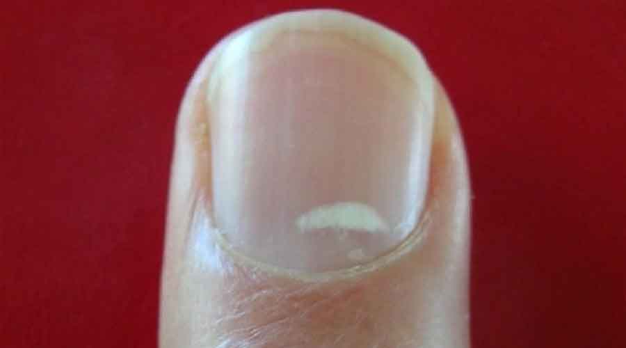 நகத்தில் வெள்ளை புள்ளிகள் Nail white marks in Tamil