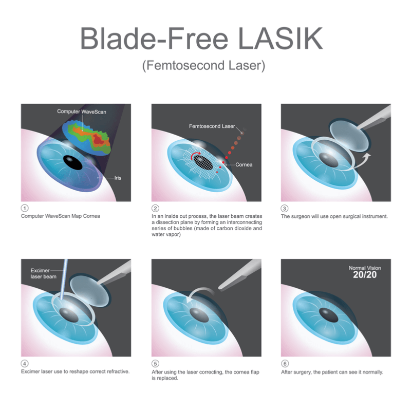 Blade vs Bladeless LASIK Surgery Diamond Vision