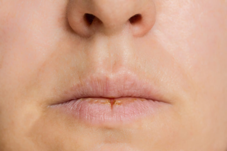 Some straightforward advice for those winterchapped lips Catching