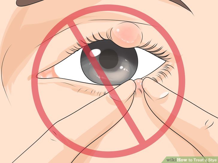 Stye Prevention and Remedies Eye Stye Treatment