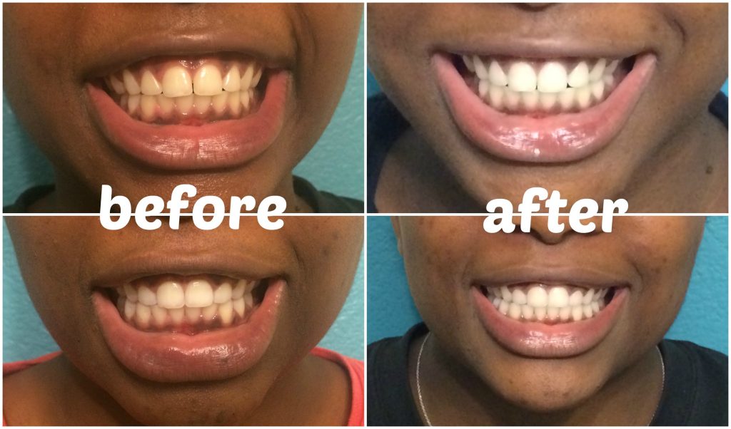 Does Activated Charcoal Whiten Teeth?