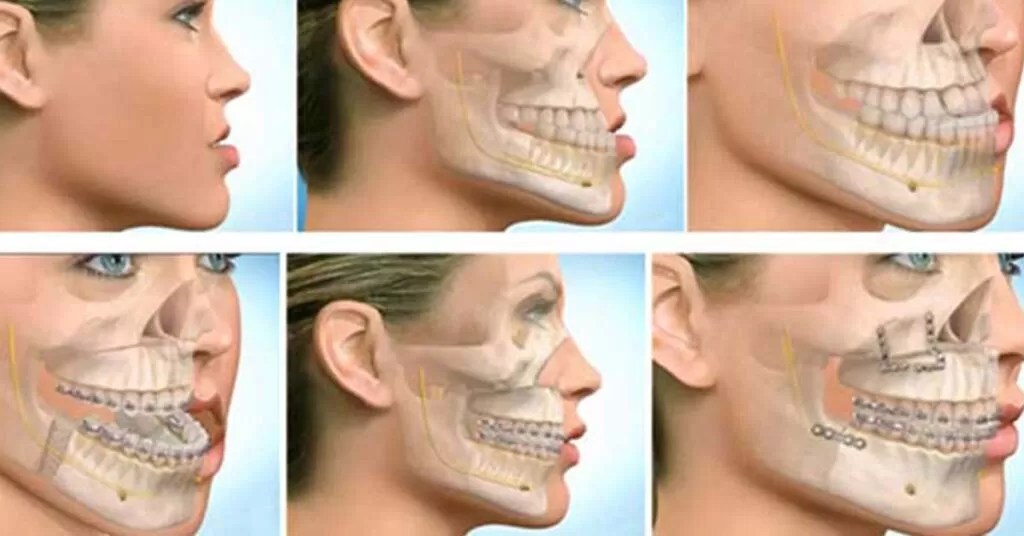 Maxillofacial Surgery Everything You Need To Know!