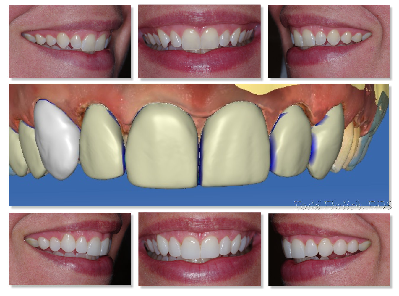 CEREC Omnicam and Emax CAD Impulse Veneers Digital Enamel