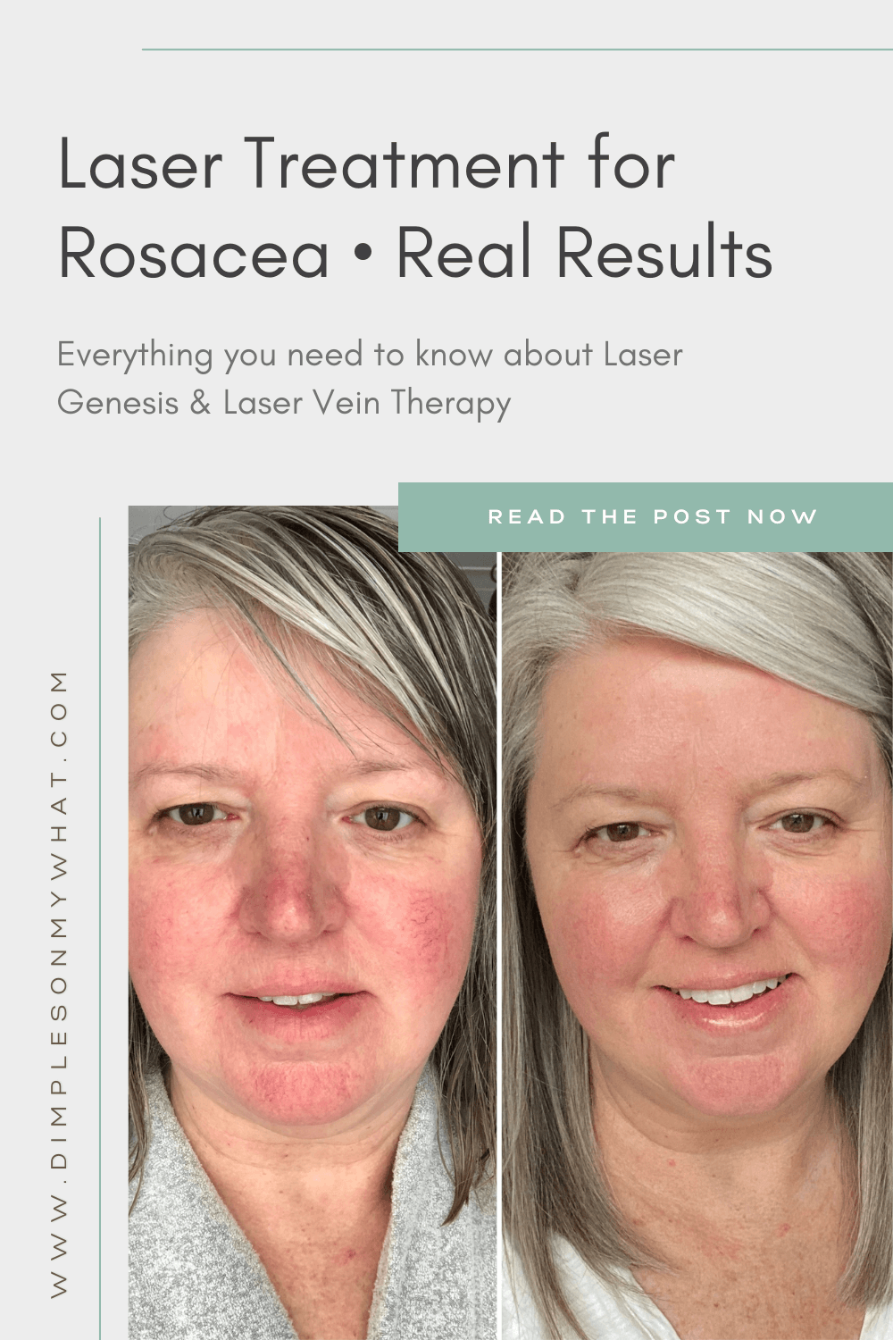 My Experience with Laser Treatment for Rosacea including Before & After