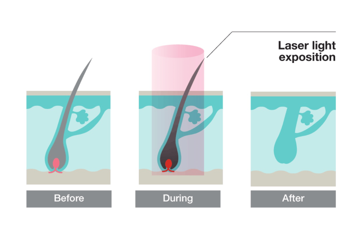 The Comparison of Diode Laser Hair Removal and IPL.dimyth