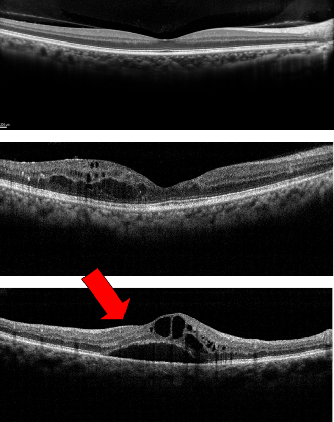 It’s All About ME What to Know About Macular Edema Discovery Eye