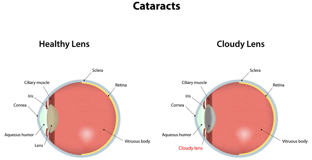 Cataract Prevention Discovery Eye Foundation