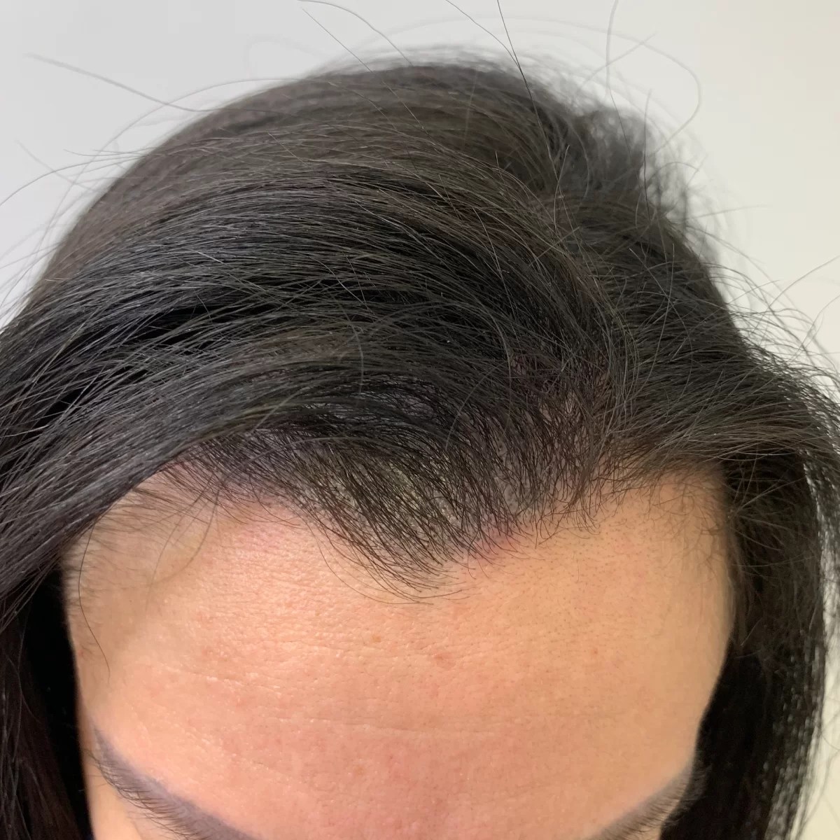 Scalp Micropigmentation Discreet