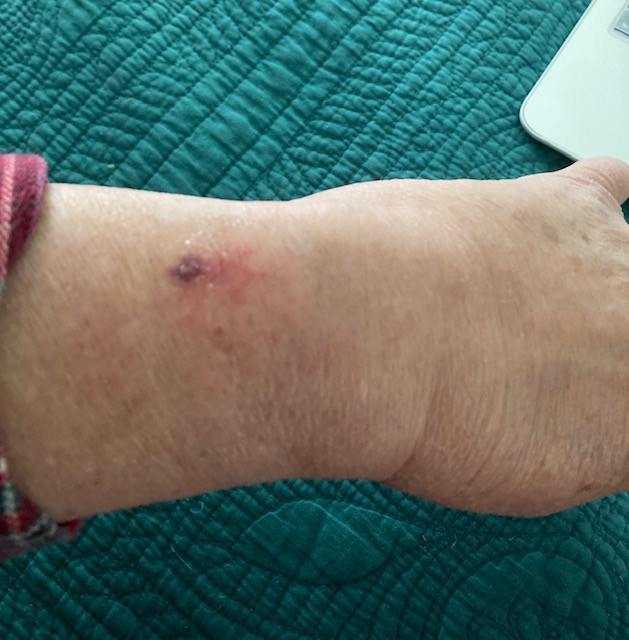 My Apple Watch burn my wrist Apple Community