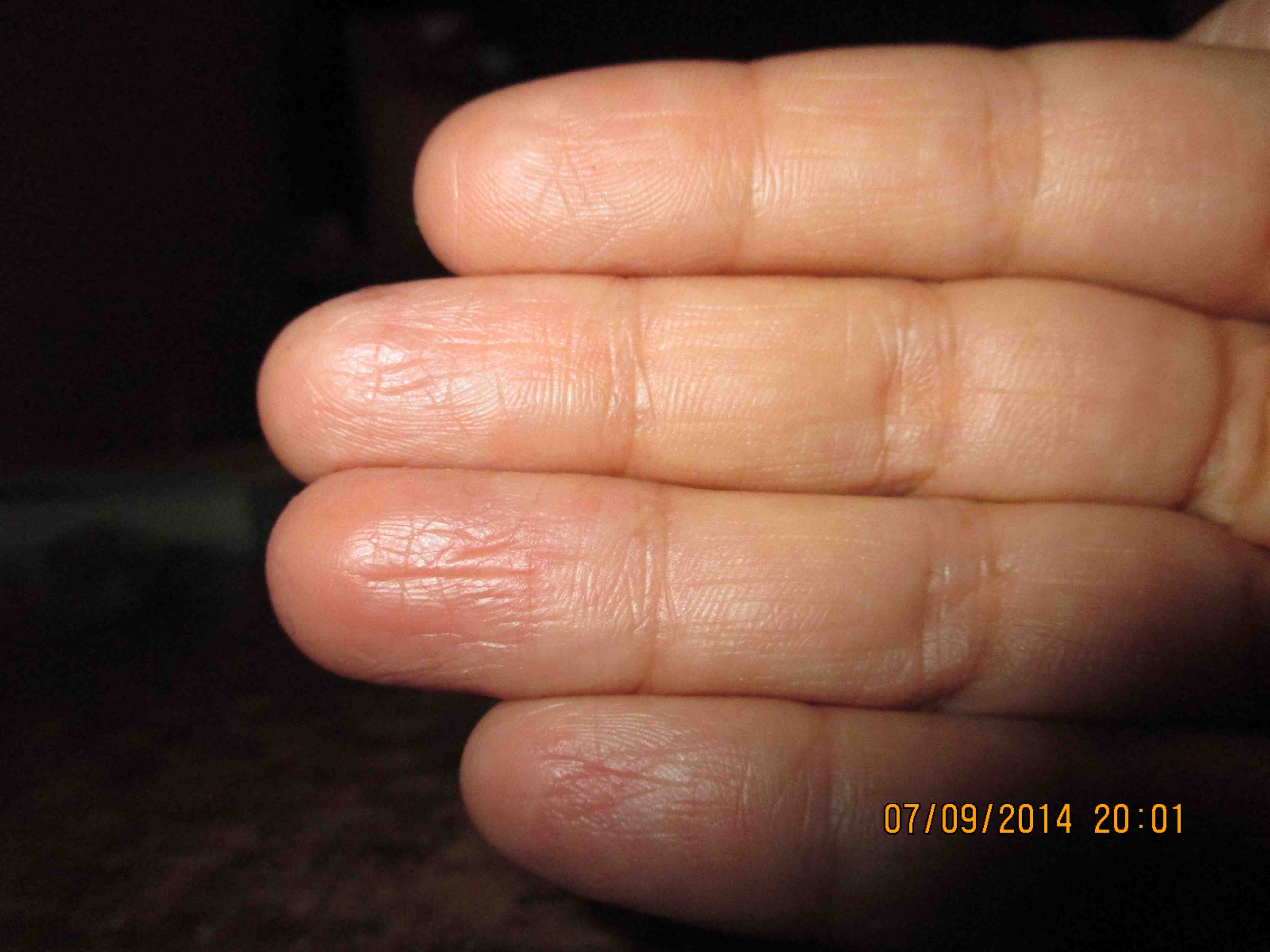 Soreness and numbness in fingertips from … Apple Community