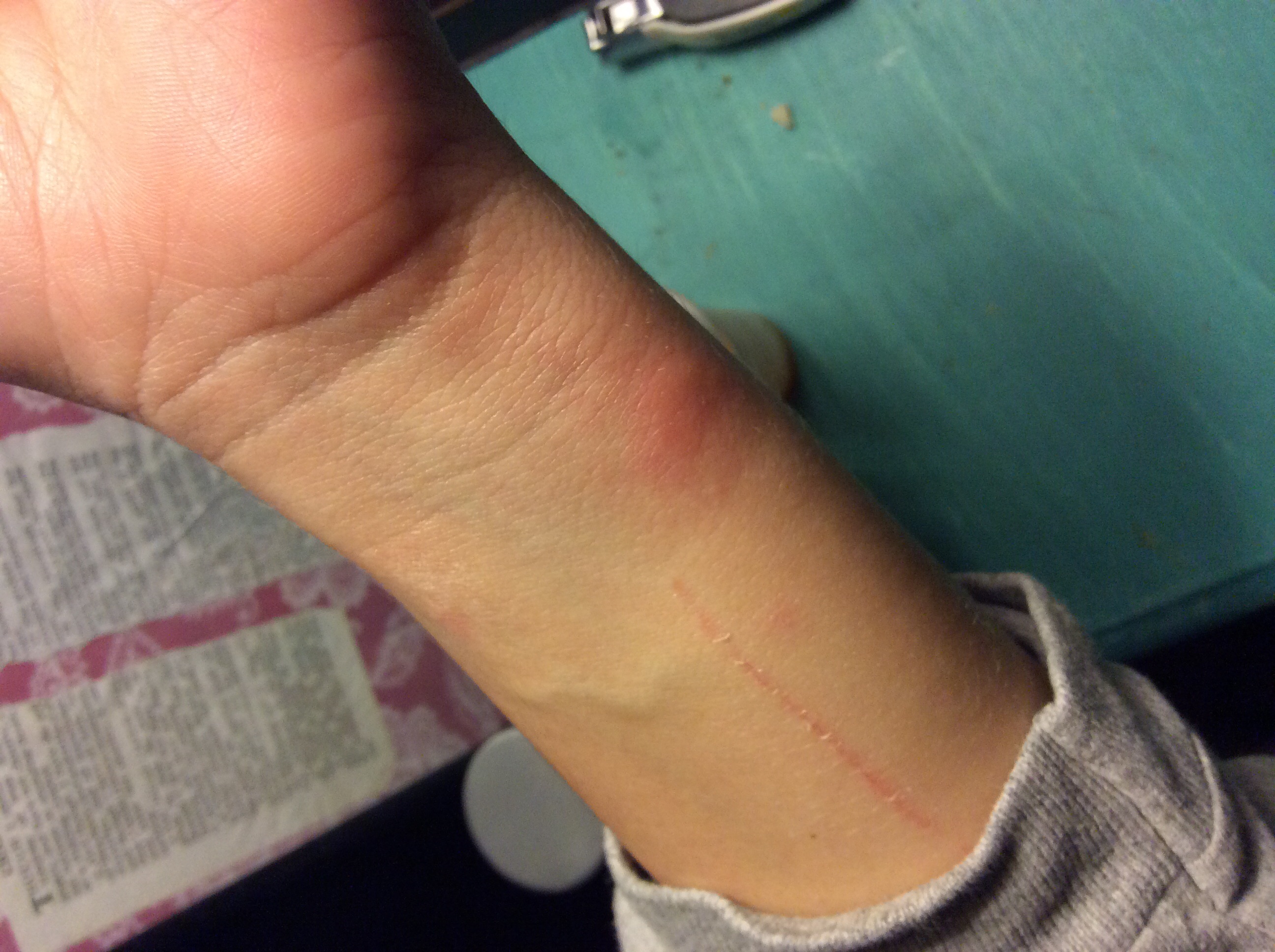 Apple watch sport rash issue Apple Community