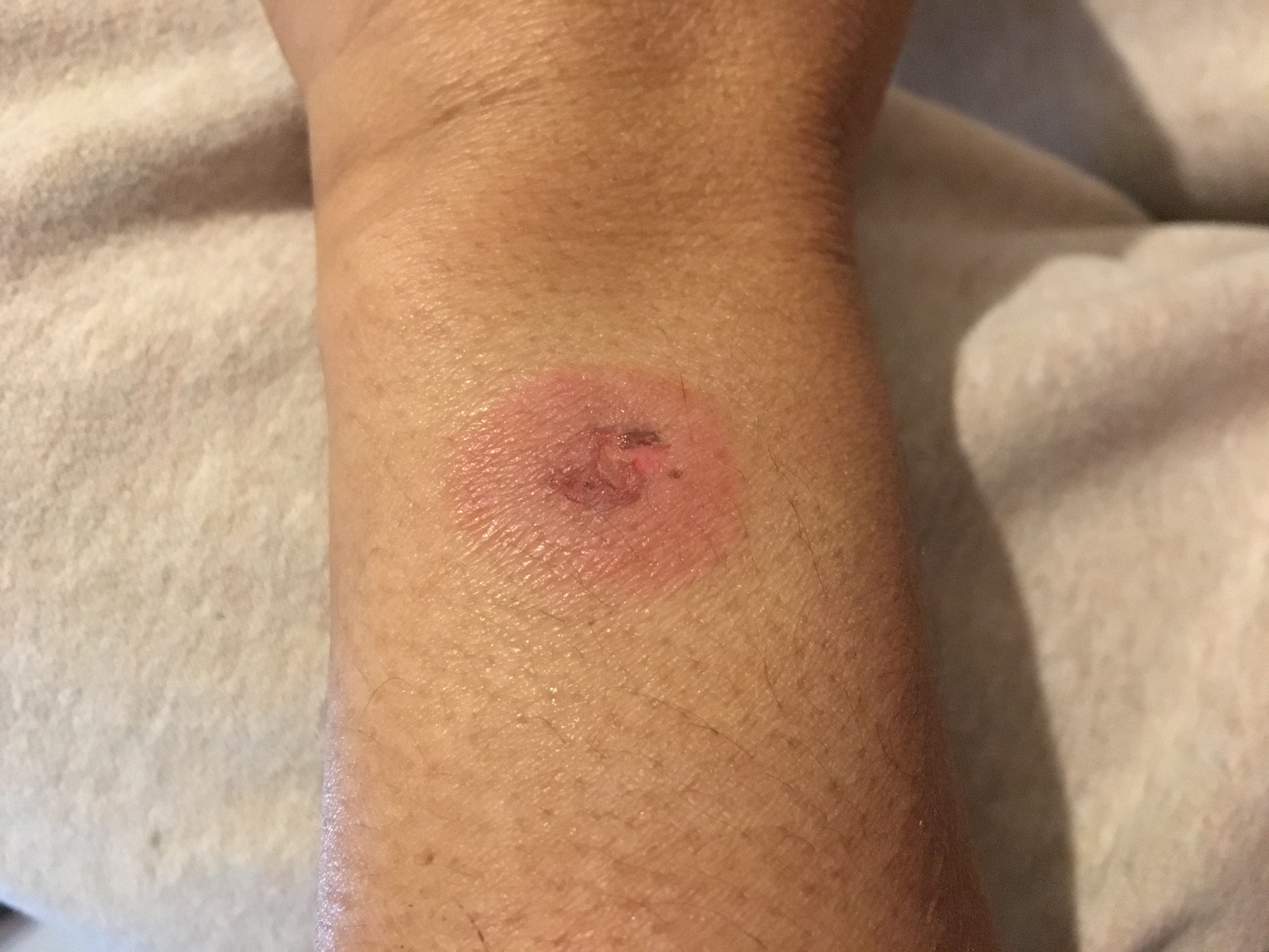Apple Watch burned my wrist Apple Community