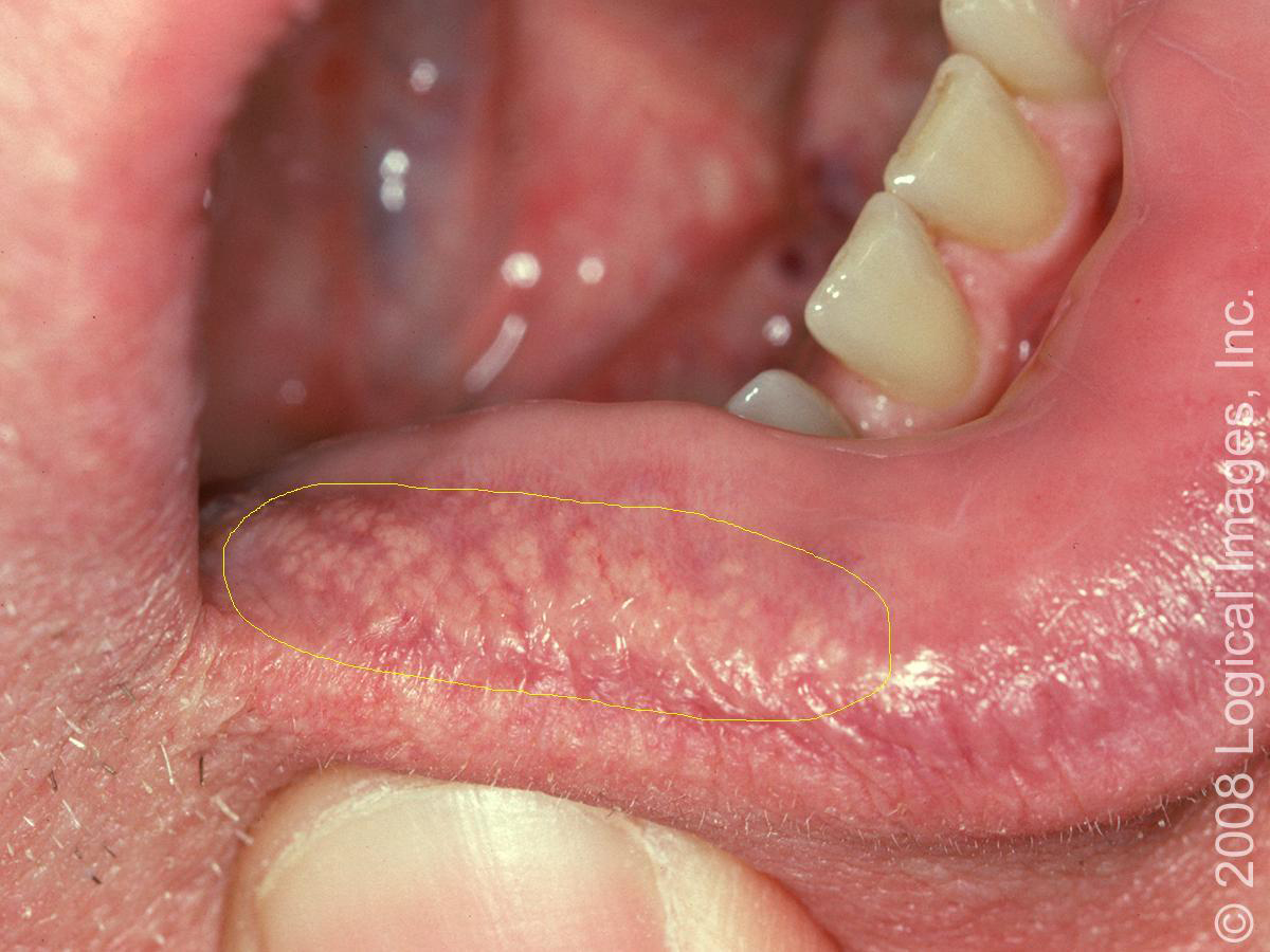 lesions on lips pictures, photos