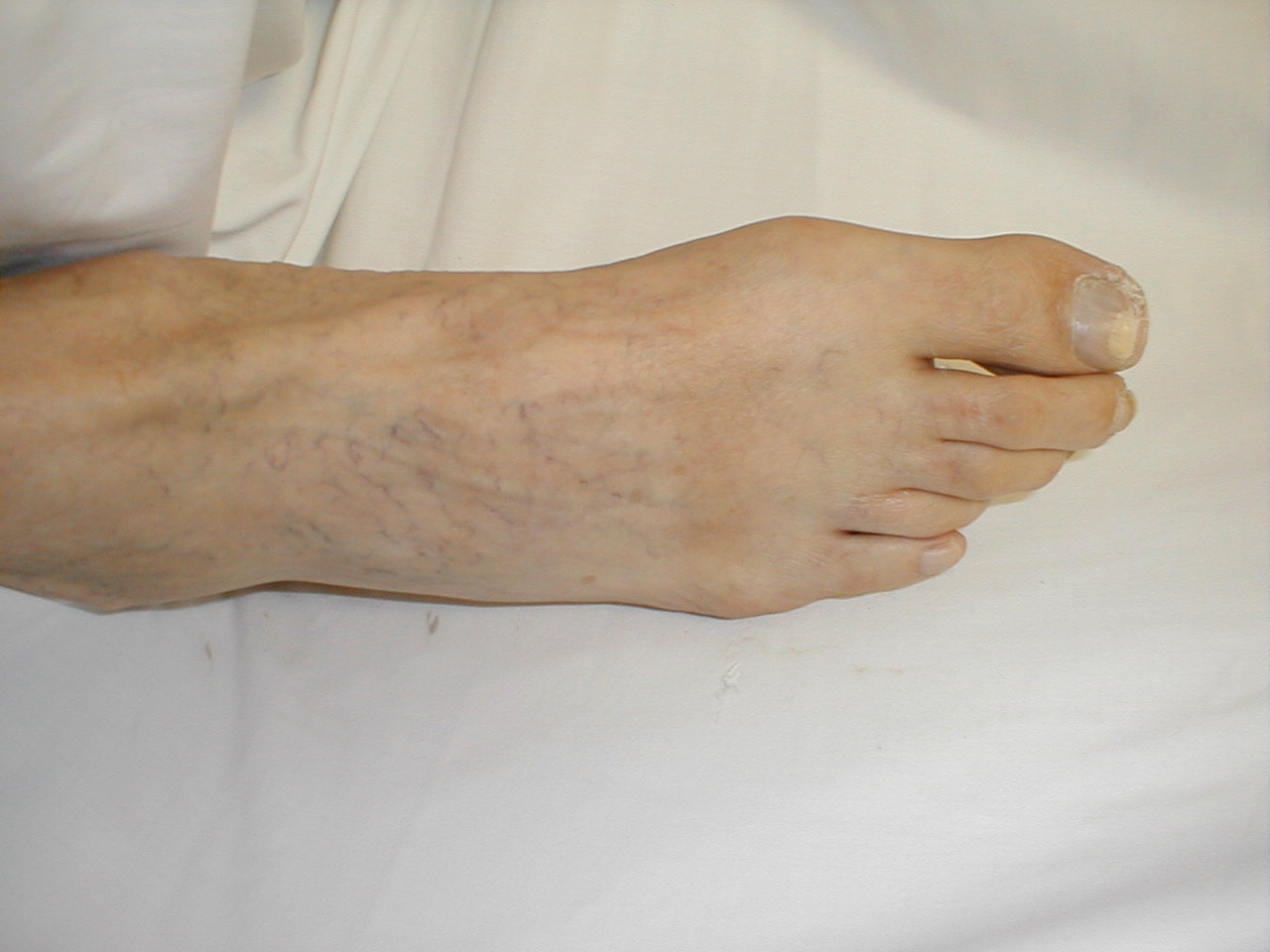 cellulitis on foot pictures, photos