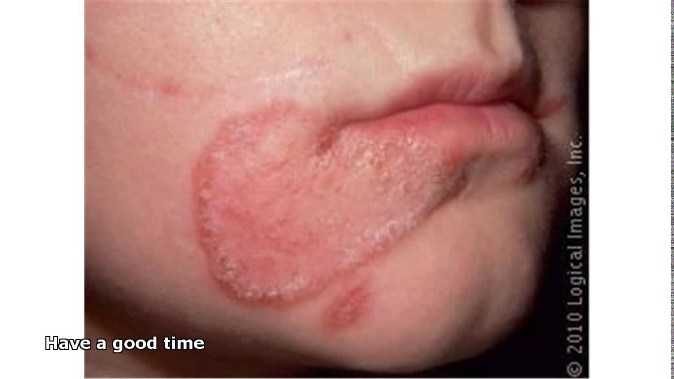 bacterial infection on face pictures, photos