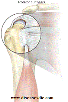 Shoulder Impingement Syndrome Causes And Diagnosis