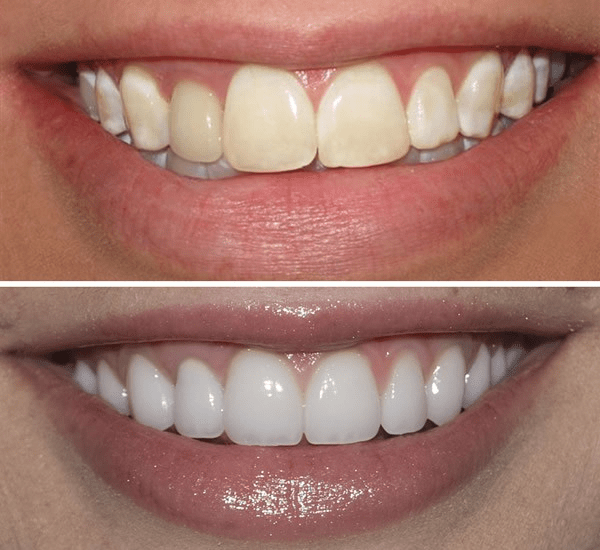 Teeth Whitening Diss Dental Health Centre