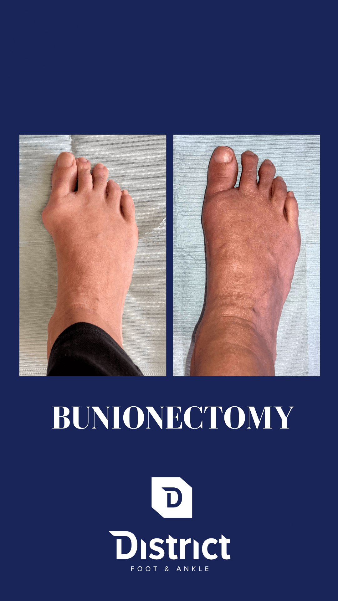Foot Bunion Treatment Surgery Doctor Alexandria, Northern VA