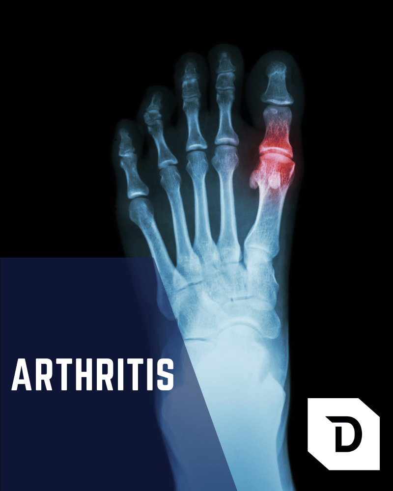 Arthritis, Joint Inflammation Treatment Alexandria, VA