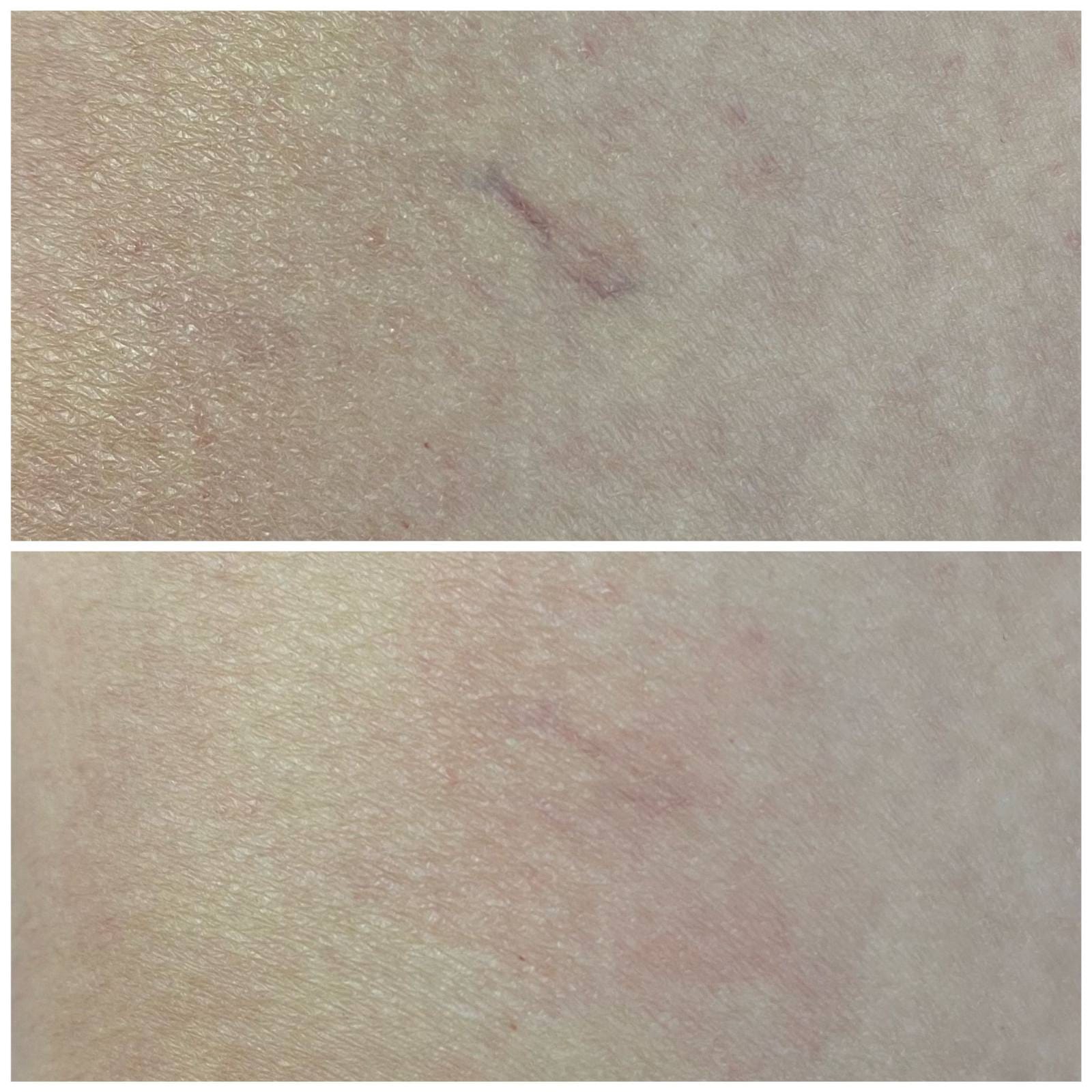 Uklanjanje kapilara laserom u Diva laser centru Diva Medical & Laser