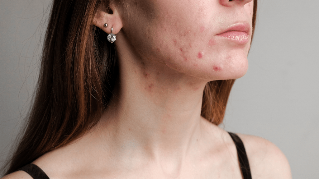 PCOS and Acne The Connection, Causes, and Natural Treatment Options