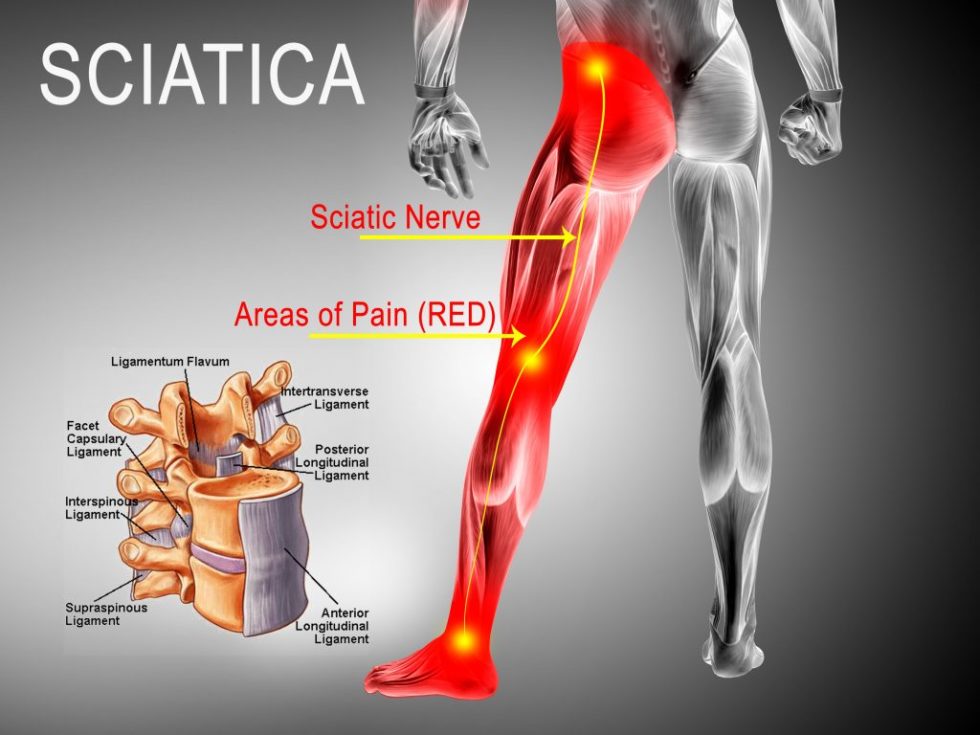 Can a Car Accident Cause Sciatica? Dixie Chiropractic St. Utah